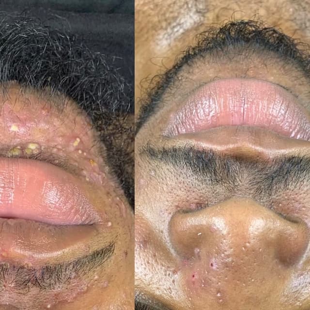 Transformation Package (8 Sessions) at High Life Image Skincare Studio in Tuscaloosa, AL